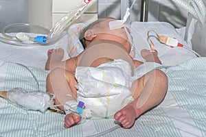 Newborn baby on breathing machine with pulse oximeter sensor and peripheral intravenous catheter at children`s hospital