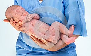 Newborn baby with chickenpox