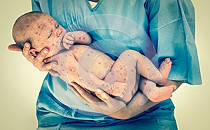 Newborn baby with chickenpox - retro style