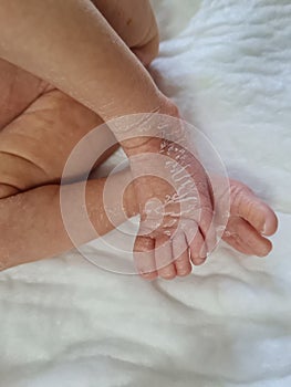 Newborn baby feet with flaky dry skin. Infant after born with very dry, wrinkled, cracked skin on foot