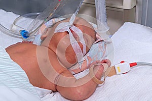 Newborn baby with hyperbilirubinemia on breathing machine with pulse oximeter sensor in neonatal intensive care unit at children`s