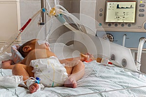 Newborn baby with hyperbilirubinemia on breathing machine with pulse oximeter sensor and peripheral intravenous catheter in neonat