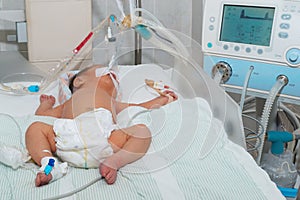 Newborn baby with hyperbilirubinemia on breathing machine or ventilator with pulse oximeter sensor and peripheral intravenous cath