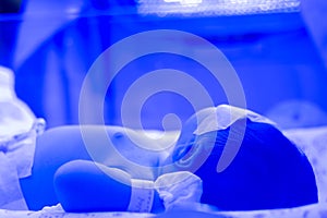 Newborn baby with hyperbilirubinemia / Neonatal jaundice under blue UV light for phototheraphy on infant warmer in neonatal