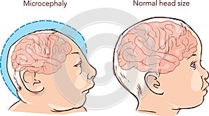 Newborn baby with Microcephaly disease caused photo