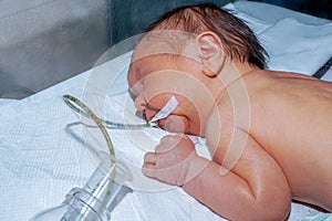 Newborn baby with neonatal jaundice is sleeping after surgery