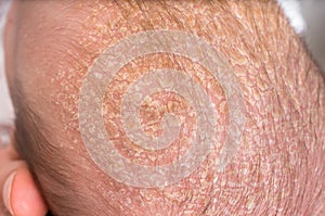Newborn baby with psoriasis or dandruff in the hair