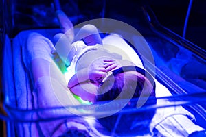 Newborn baby receiving phototherapy for jaundice