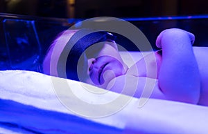 Newborn baby receiving phototherapy for jaundice