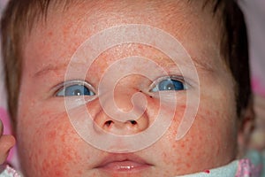 Newborn Baby With Severe Baby Acne Possibly from an Adverse Reaction to Shots Given at Birth