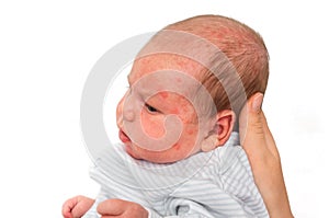 Newborn baby with skin rash. Allergic reaction after birth