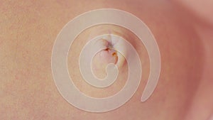 Newborn baby umbilical cord, first week of life.