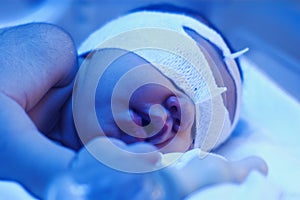 Newborn baby under ultraviolet light