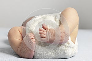 Newborn with bilateral club foot photo