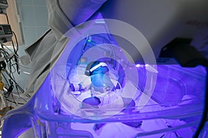 Newborn child baby having a treatment for jaundice under ultraviolet light in incubator