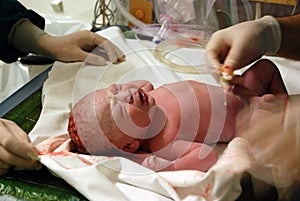 Newborn: cutting the umbilical cord