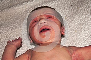 Newborn with easy baby acne on the face possibly from an adverse reaction to shots given at birth