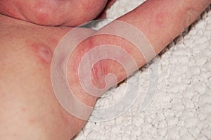 Newborn with easy baby acne possibly from an adverse reaction to shots given at birth