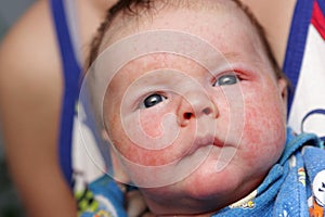 Newborn has eczema photo