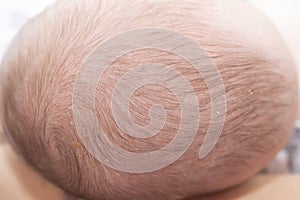 Newborn head with cradle cap photo