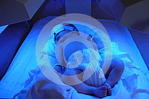 Newborn jaundice