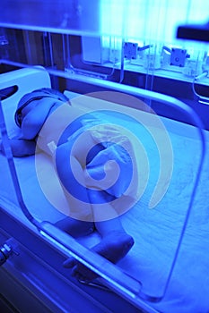 Newborn jaundice