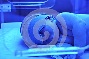Newborn jaundice