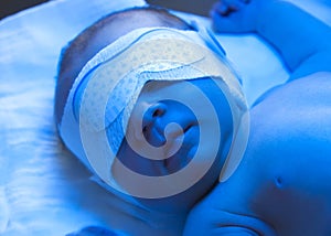 Newborn jaundice treatment photo
