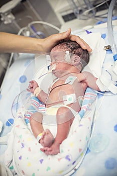 Newborn premature baby in the NICU intensive care