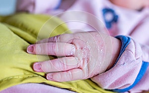 Newborns skin peeling