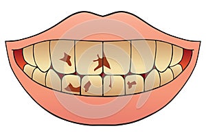 Nicotine Stained Teeth photo
