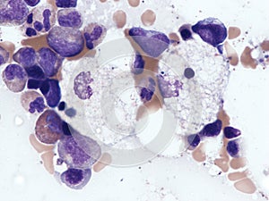 Niemann–Pick cells in bone marrow