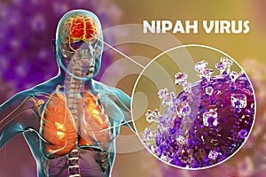 Nipah virus infection