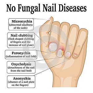 No Fungal Nail Disease photo