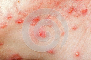 Nodular cystic acne skin