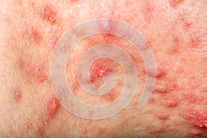 Nodular cystic acne skin photo