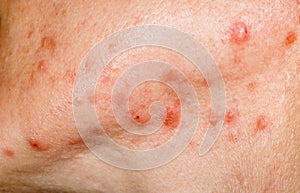 Nodulocystic acne on human skin