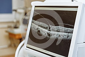 Non-contact optical coherence tomograph for visualization of the anterior and posterior segments of the eyeball. Medical equipment