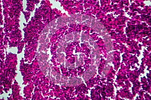 Non-Hodgkin`s lymphoma, light micrograph