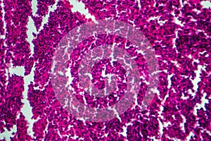 Non-Hodgkin`s lymphoma, light micrograph photo