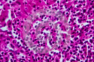 Non-Hodgkin`s lymphoma, light micrograph photo