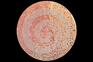 Non small cell pulmonary lung carcinoma