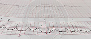 Non stress test paper, medical care for monitoring fetal heart rate and maternal uterine contractions in preterm pregnancy.