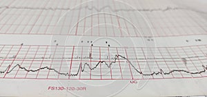 Non stress test paper, medical care for monitoring fetal heart rate and maternal uterine contractions in preterm pregnancy.