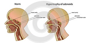 Norm and hypertrophy of adenoids. Location of adenoids.