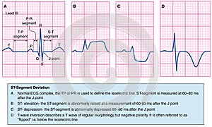 Normal and abnormal ecg traces