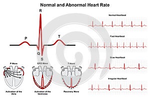 Normal and abnormal human heart beat rate infographic diagram photo