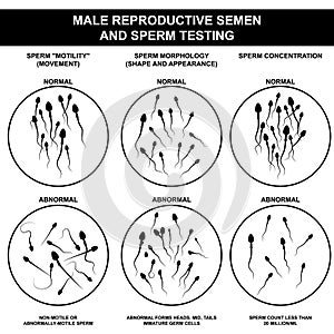Normal and abnormal sperm