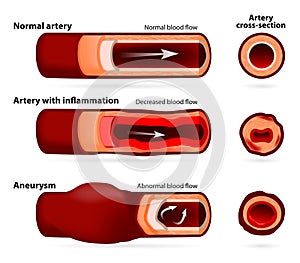 Normal artery, inflamed or narrowed artery and artery with an an