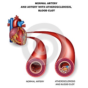 Normal artery and unhealthy artery